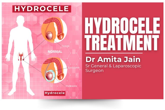 Laparoscopic Surgeon Dr Amita Jain Dr Amita Jain best Hydrocele treatment and Surgery